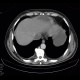 Renal carcinoma, tumorous thrombosis of inferior vena cava, pericardial metastasis: CT - Computed tomography